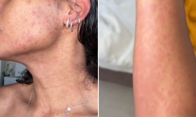 influenciadora é mordida por macaco